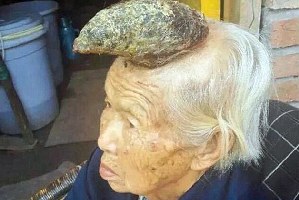 老太头上长出独角:长约13厘米 或是皮角或是肿