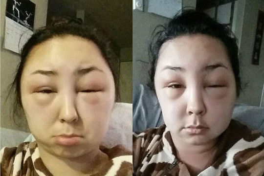 美女对染发剂过敏秒变"外星人":脸都肿了，眼睛睁不开▏染发剂 外星人 妹纸 美女 围观 过敏反应 浮肿 Imgur 皮肤测试 睁开_社会新闻_南方网