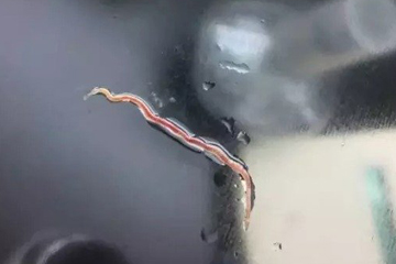 嘉兴一女子咳出6条活虫 不在医学寄生虫范畴▏