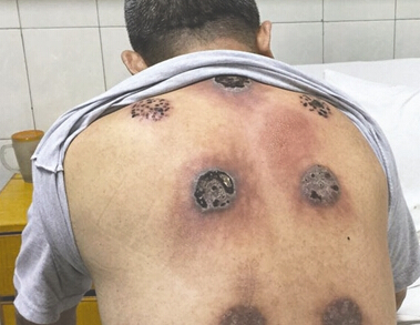 惊呆!大爷拔一个月火罐 背上烧出7个洞(图)▏