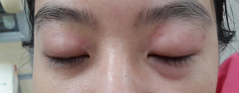 女子一觉醒来 眼睛竟肿成这样